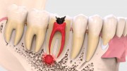 Резидуальная киста зуба
