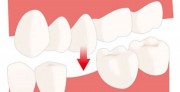 Причины смещения зубов