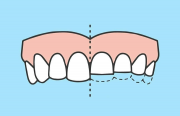 Лечение стираемости зубов