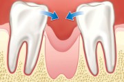 Лечение смещения зубов