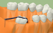 Использование микроимплантов в ортодонтии