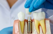 Как восстановить зубы?