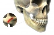 Перелом скуловой кости