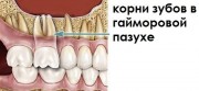 Корень зуба в гайморовой пазухе