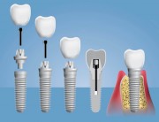 Этапы имплантации зубов у пациентов