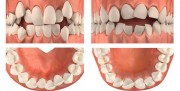 Причины аномалии зубов