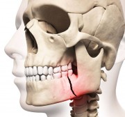 Травмы челюстно-лицевой области