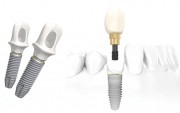 Виды имплантов зубов и популярные бренды