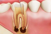 Сколько живет зуб без нерва?