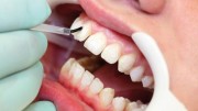Бондинг в стоматологии