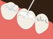 Как ставят пломбы на зубы?