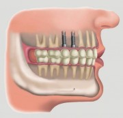 Имплантация 6 нижнего и верхнего зуба