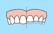 Лечение патологической стираемости зубов