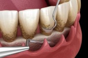 Как вставить зубы при пародонтозе?
