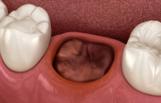 Белый нарост после удаления зуба