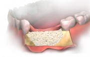 Формирование костной ткани после удаления зуба