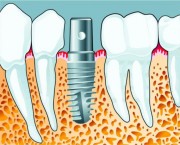 Когда после удаления зуба можно протезировать и ставить коронку?