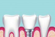 Больно ли ставить импланты зубов?