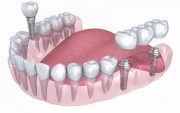 Традиционные и новые виды протезирования зубов