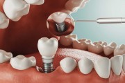 Новые технологии в имплантации зубов