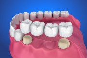 Зубной мост в стоматологии