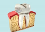 Как избежать эрозии зубной эмали?