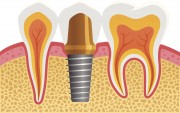 Отторжение зубного импланта в полости рта