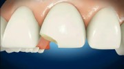Восстановление скола переднего зуба