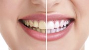 Как отбелить зубы после снятия брекетов?