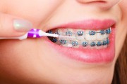 Разрушаются ли зубы от брекетов?