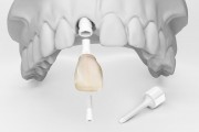Зубные коронки на импланте
