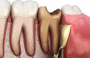 Лечение разных видов воспаления надкостницы зуба