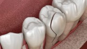 Трещина в зубе после удара