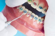 Как подготовить зубы к ортодонтическому лечению?