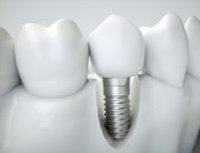 Как ухаживать за зубными имплантами?