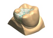 Керамические вкладки в стоматологии