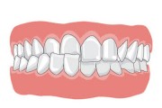 Деформация зубных рядов