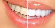 Как правильно выбрать способ отбеливания зубов?