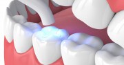 Сколько держится временная пломба в зубе?