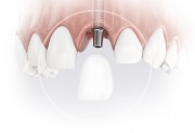 Какие импланты передних зубов лучше выбрать?