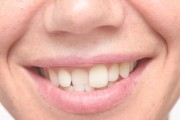 Почему зубы могут стать кривыми?