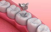 5 основных причин выпадения зубной пломбы