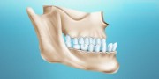Лечение прикуса у взрослых в ортодонтии
