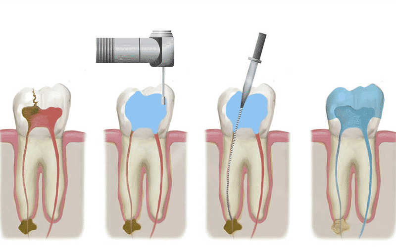 Удаление нерва зуба: показания, как удаляют, зуб после удаления