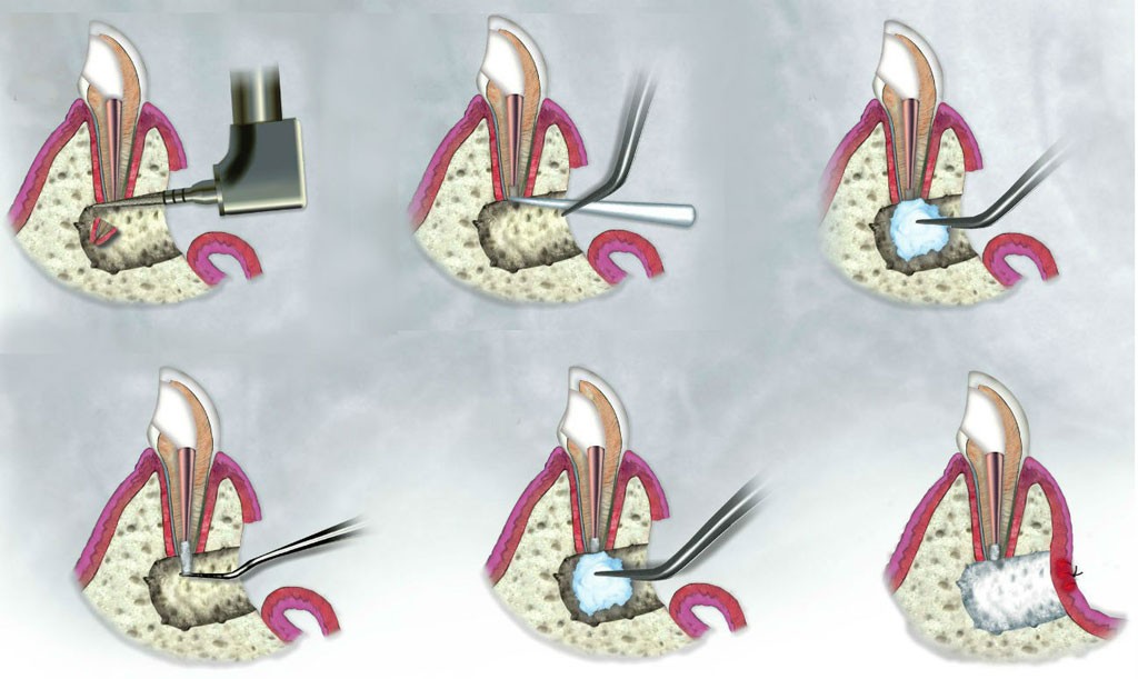 Удаление кисты зуба Томск Производственный стоматология на совпартшкольном томск врачи
